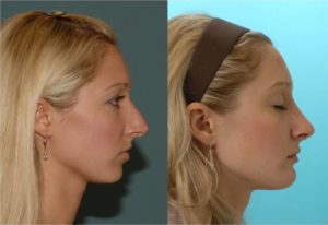 nose-reshaping
