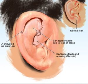 Common causes of ear misshape