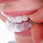 Dental Braces Structural and Aesthetic Benefits and How They Work