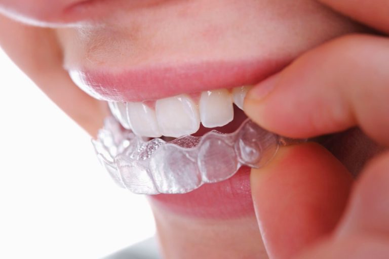 Dental Braces: Structural and Aesthetic Benefits and How They Work