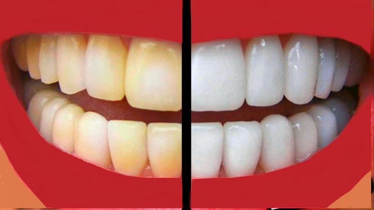 Simple Ways to Keep Your Teeth and Gums Healthy