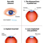 Cataract Treatment in Navi Mumbai